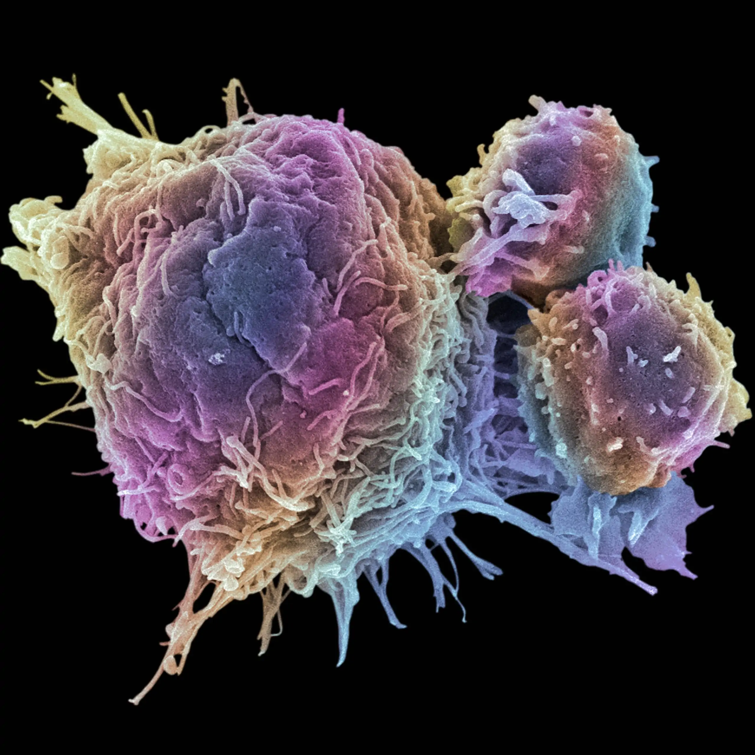 Cancer Cell and T Lymphocytes